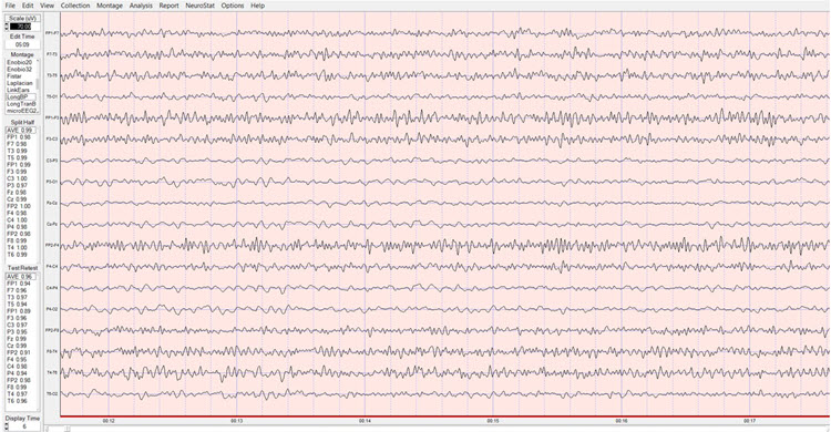 Longitudinal bipolar montage eyes-open pre-training baseline
